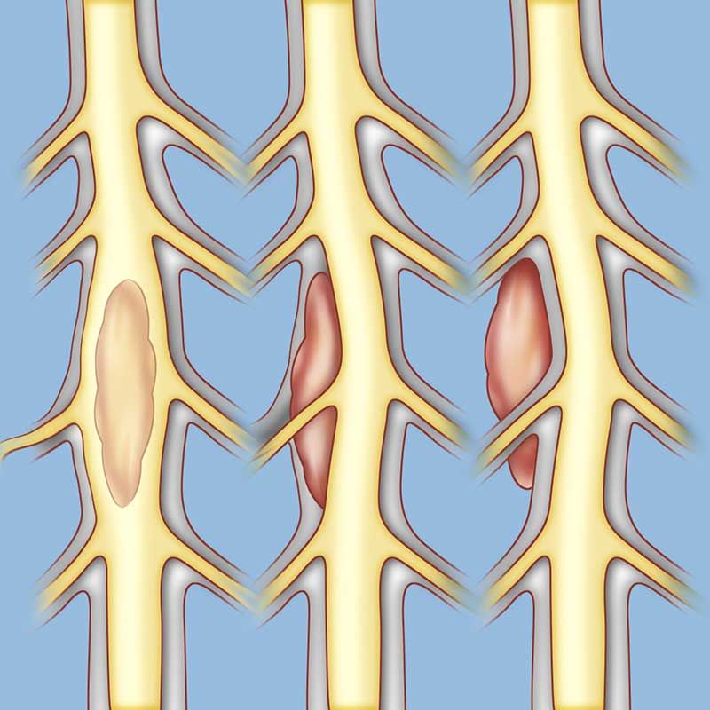 Treatment Options of intradural spinal tumors
