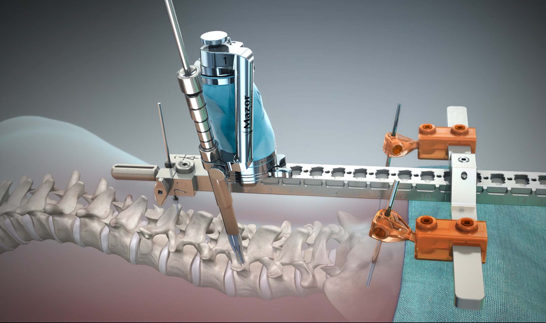 Spine Restoration Surgery